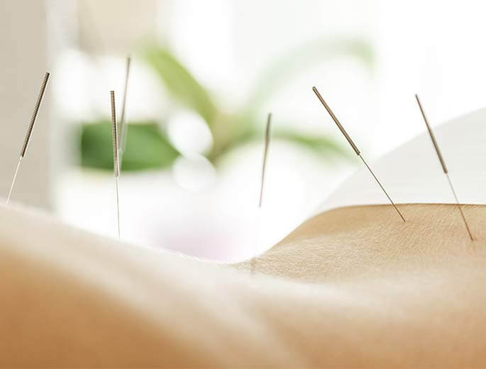 Akupunktur Nadeln